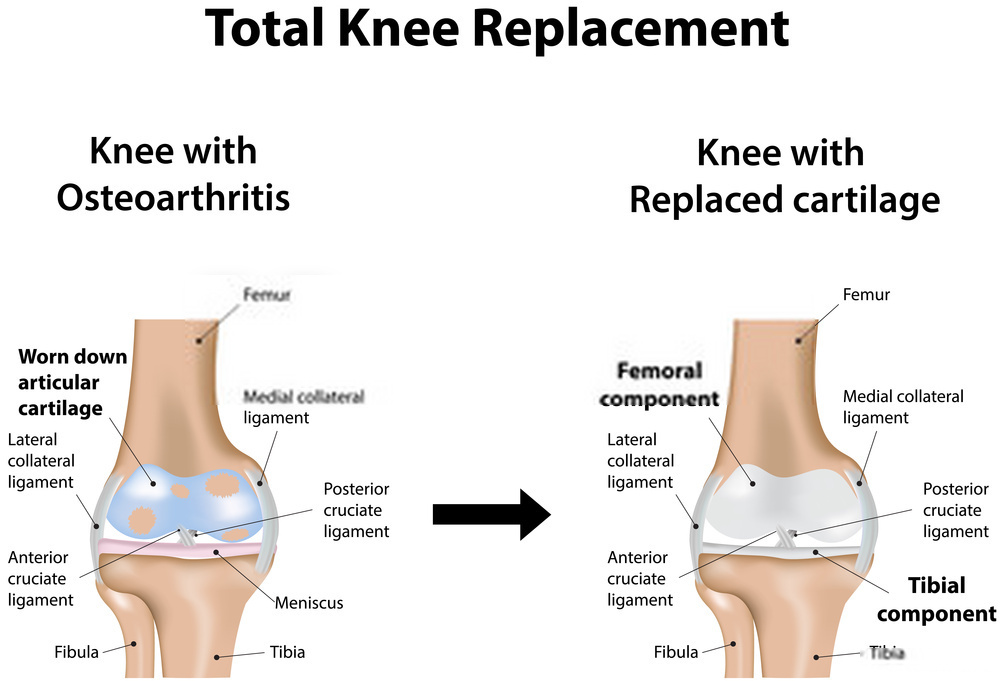 Knee replacement surgery